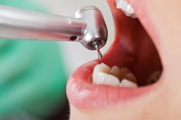 Best Emergency Treatment for Dental Infections or Abscesses in Rose Valley, PA